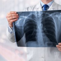 Hlavní obrázek - Pacientům s idiopatickou plicní fibrózou už nikdo léčbu nevysadí